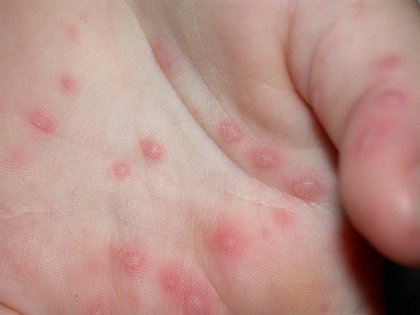 toddler heat rash pictures. Preschool , Toddler,005
