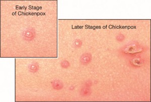 chickenpox