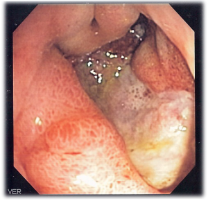 Deep_gastric_ulcer